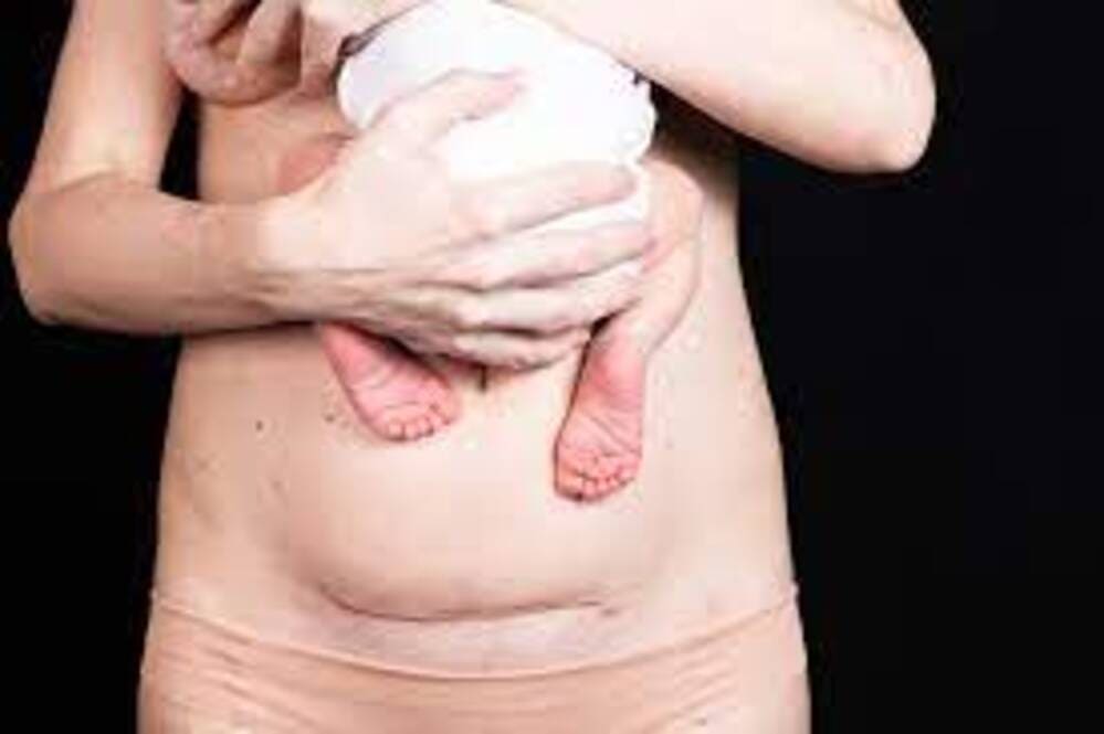 Conseguenze della cicatrice da taglio cesareo: Un caso clinico | Barbara Colombo Blog