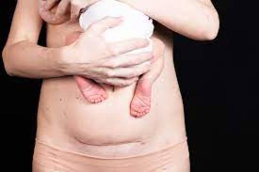 CONSEGUENZE DELLA CICATRICE DA TAGLIO CESAREO: UN CASO CLINICO